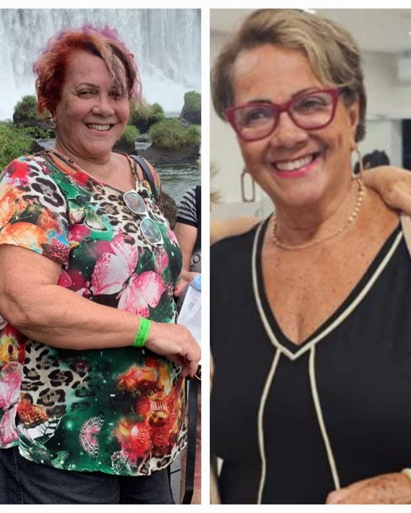 Antes e depois de Paciente da Alyne, 50+